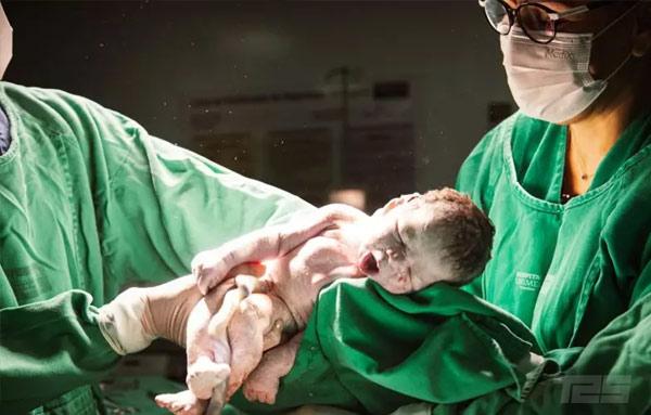 Substâncias presentes no cordão umbilical podem ser a causa do autismo